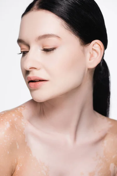 Retrato de joven hermosa mujer con vitiligo aislado en blanco - foto de stock