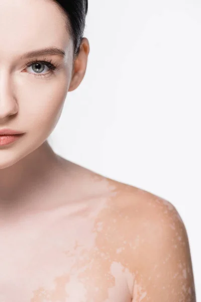 Portrait de jeune belle femme avec vitiligo isolé sur blanc — Photo de stock