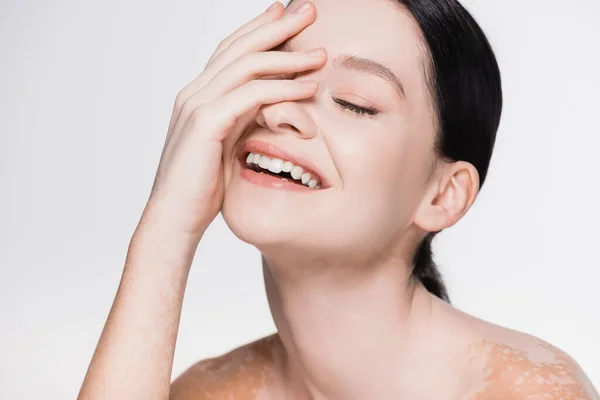 Sonriente joven hermosa mujer con vitiligo aislado en blanco - foto de stock
