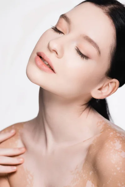 Jovem mulher bonita com vitiligo e olhos fechados isolados em branco — Fotografia de Stock