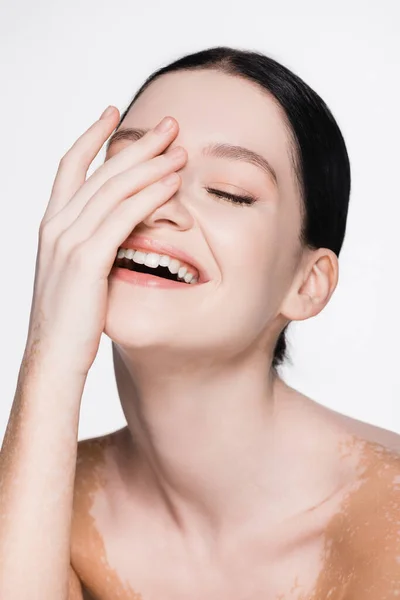 Smiling young beautiful woman with vitiligo isolated on white — Stock Photo