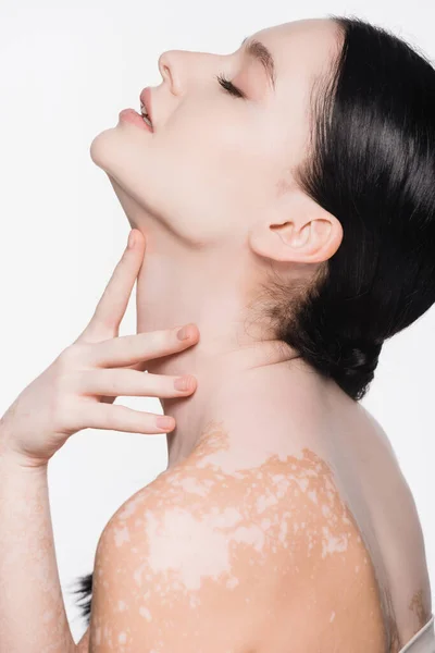 Side view of young beautiful woman with vitiligo isolated on white — Stock Photo