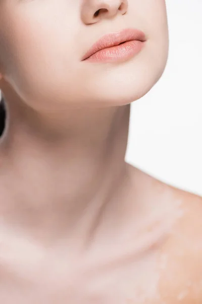 Recortado vista de joven hermosa mujer con vitiligo aislado en blanco - foto de stock