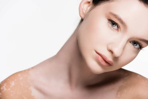 Junge schöne Frau mit Vitiligo isoliert auf weiß — Stockfoto