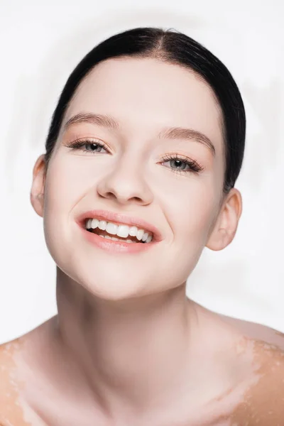 Sourire jeune belle femme avec vitiligo isolé sur blanc — Photo de stock