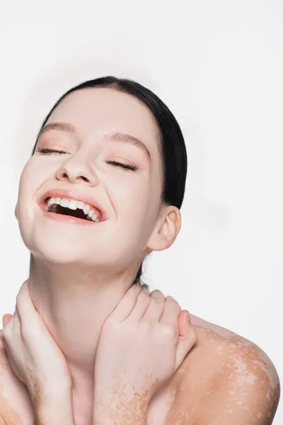 Rire jeune belle femme avec vitiligo isolé sur blanc — Photo de stock