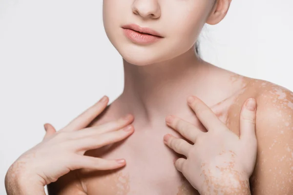 Cropped view of young beautiful woman with vitiligo isolated on white — Stock Photo