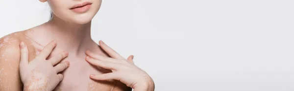 Vista cortada de jovem mulher bonita com vitiligo isolado em branco, banner — Fotografia de Stock