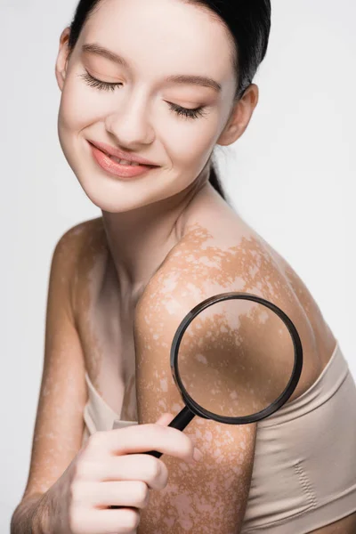 Smiling young beautiful woman with vitiligo holding magnifying glass isolated on white — Stock Photo