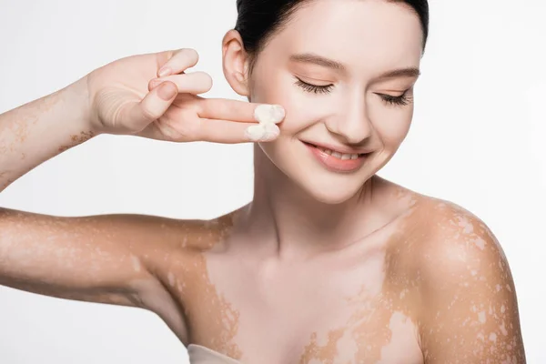 Smiling young beautiful woman with vitiligo applying cosmetic cream isolated on white — Stock Photo