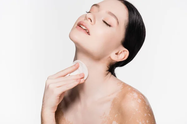 Young beautiful woman with vitiligo cleansing neck with cotton pad isolated on white — Stock Photo