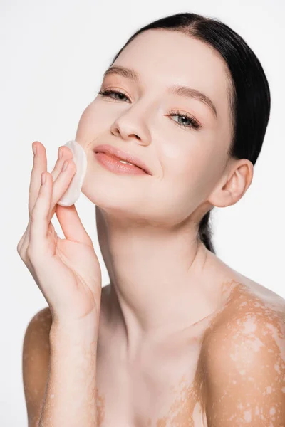 Sorrindo jovem mulher bonita com vitiligo rosto de limpeza com almofada de algodão isolado no branco — Fotografia de Stock