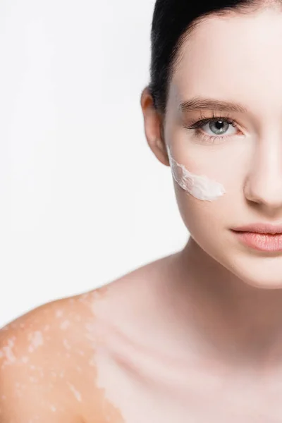 Vista ritagliata di giovane bella donna con vitiligine e crema viso sulla guancia isolato su bianco — Foto stock