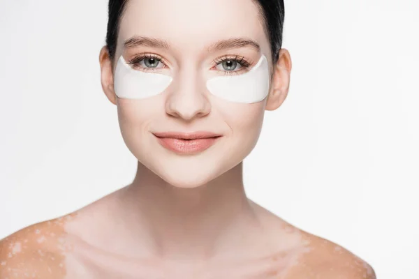 Young beautiful woman with vitiligo and eye patches on face isolated on white — Stock Photo