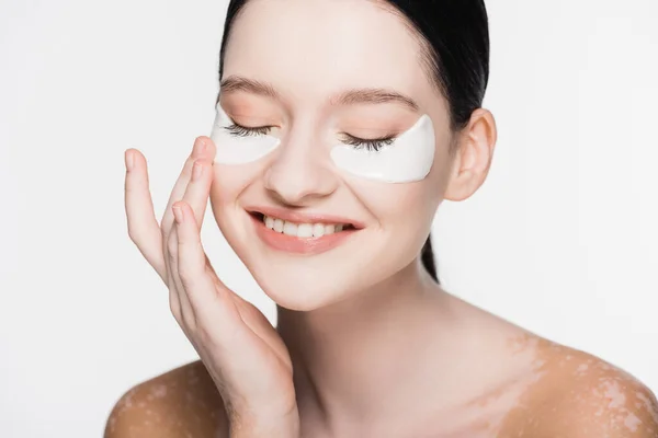 Smiling young beautiful woman with vitiligo and eye patches on face isolated on white — Stock Photo