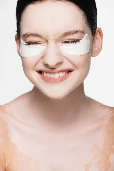 Sonriente joven hermosa mujer con vitiligo y parches en los ojos en la cara aislado en blanco - foto de stock