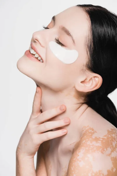 Sonriente joven hermosa mujer con vitiligo y parches en los ojos en la cara aislado en blanco - foto de stock