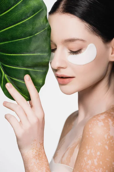 Young beautiful woman with vitiligo and eye patches on face near green leaf isolated on white — Stock Photo