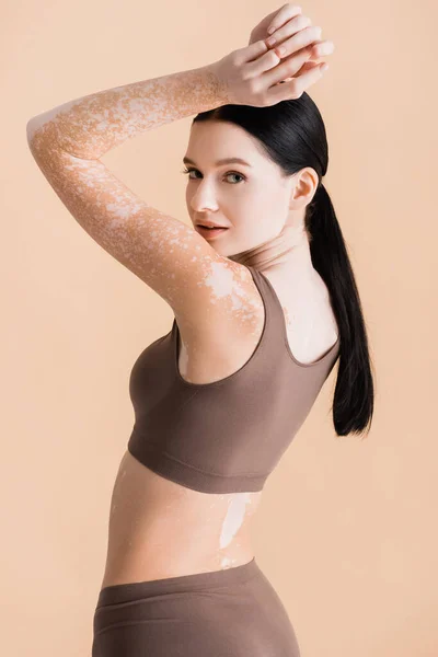 Young beautiful woman with vitiligo posing in underwear isolated on beige — Stock Photo