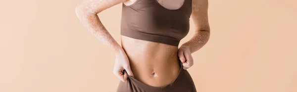 Vista recortada de la mujer con vitiligo posando en ropa interior aislado en beige, pancarta - foto de stock