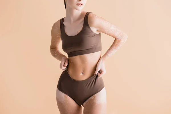 Recortado vista de joven hermosa mujer con vitiligo posando en ropa interior aislado en beige - foto de stock