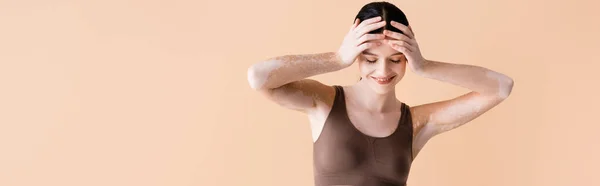 Sonriente joven hermosa mujer con vitiligo posando en ropa interior aislado en beige, pancarta - foto de stock