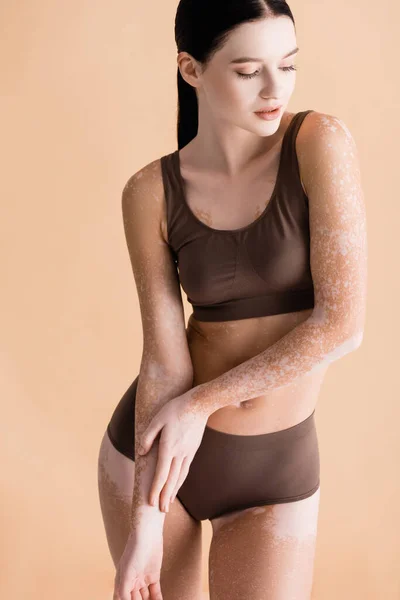 Young beautiful woman with vitiligo posing in underwear isolated on beige — Stock Photo