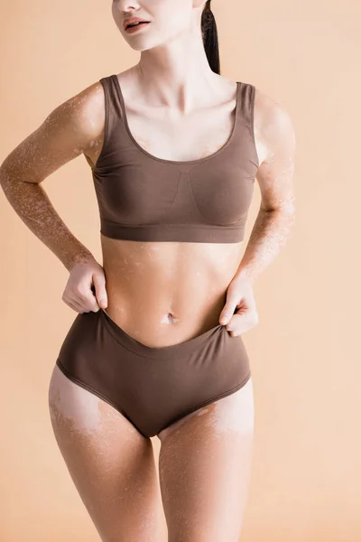 Cropped view of young beautiful woman with vitiligo posing in underwear isolated on beige — Stock Photo