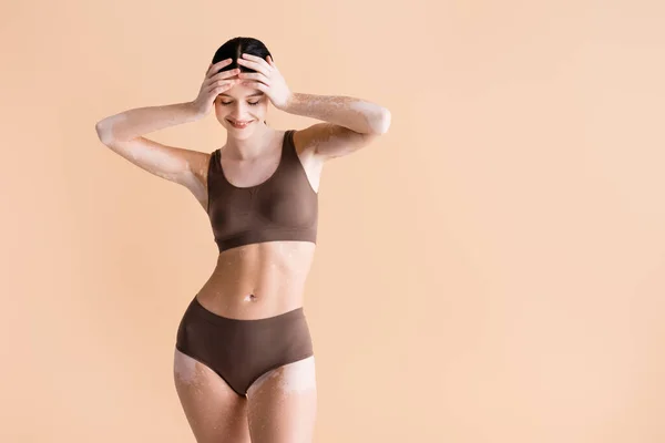 Smiling young beautiful woman with vitiligo posing in underwear isolated on beige — Stock Photo