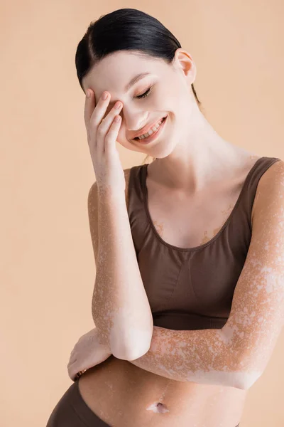 Sonriente joven hermosa mujer con vitiligo posando en ropa interior aislado en beige - foto de stock