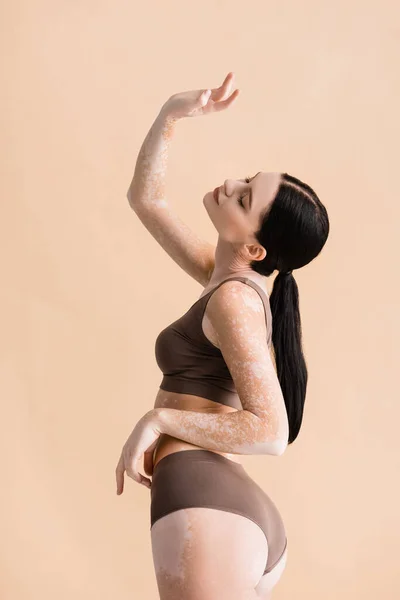 Молода красива жінка з вітіліго позує в нижній білизні ізольована на бежевому — стокове фото