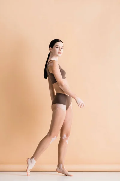 Vue latérale de jeune belle femme avec vitiligo posant en sous-vêtements sur beige — Photo de stock