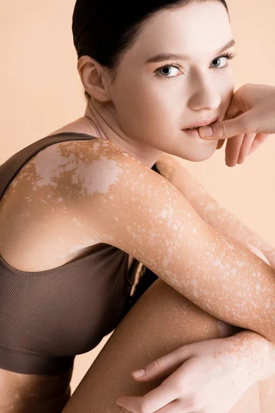 Young beautiful woman with vitiligo isolated on beige — Stock Photo