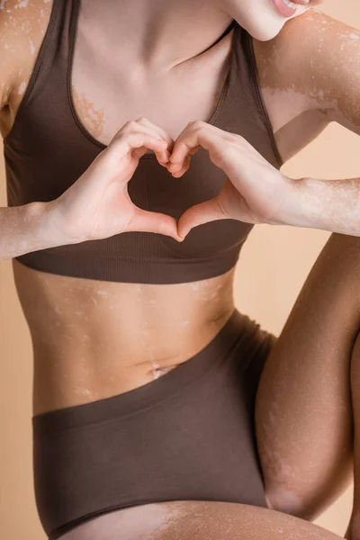 Vista cortada de mulher com vitiligo mostrando coração com as mãos isoladas no bege — Fotografia de Stock