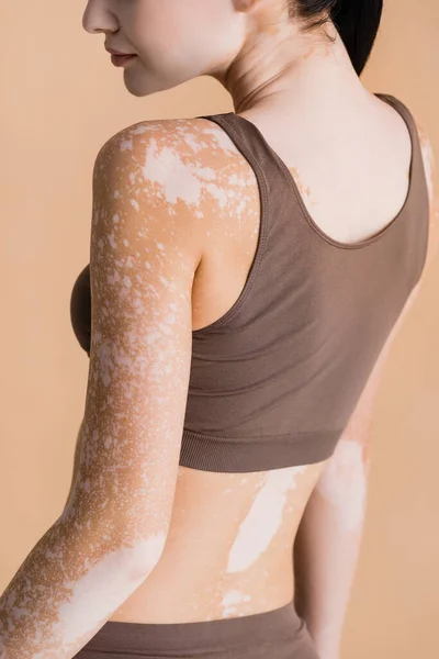 Cropped view of young beautiful woman with vitiligo isolated on beige — Stock Photo