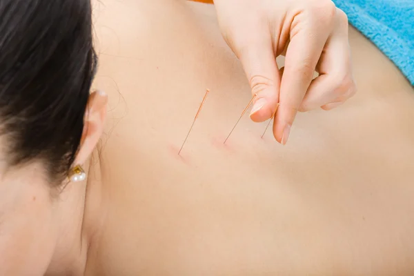 Acupuncture treatment — Stock Photo, Image