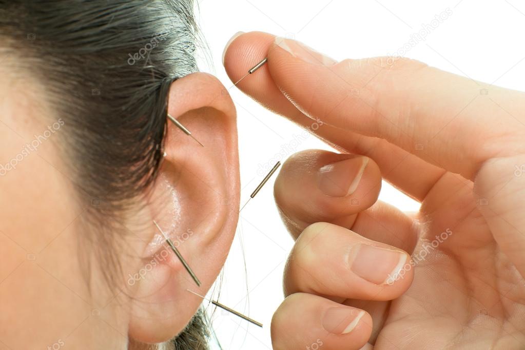 Acupuncture Stock Photo by ©tankist276 78093636