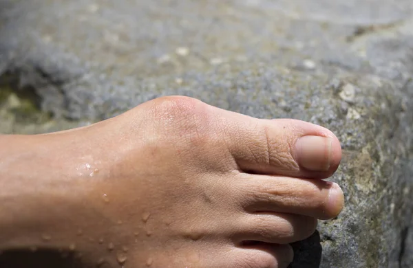 Bunion Hallux Valgus Vrouwelijke Voet Van Middelbare Leeftijd — Stockfoto