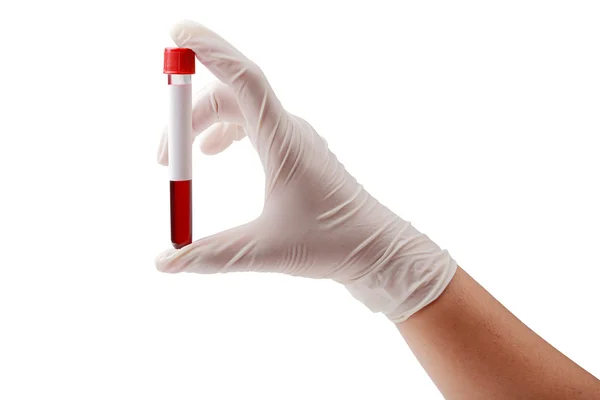 Hand holding test tube with blood plasma ready for testing isola — Stock Photo, Image