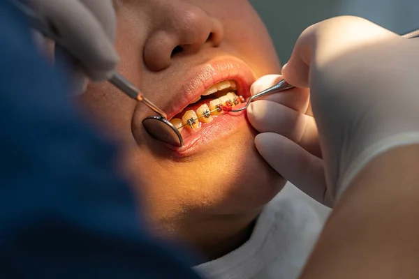 Close up photo of orthodontist checking up teeth braces for the girl — Stock Photo, Image