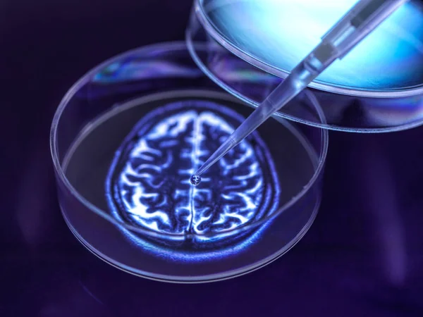 Концептуальне Зображення Досліджень Ліки Від Розладів Мозку Таких Деменція Альцгеймер — стокове фото