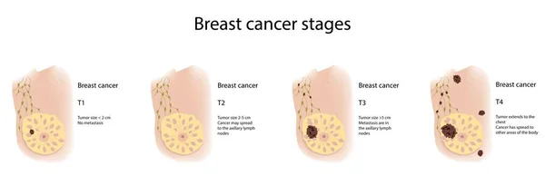 Stadi Cancro Seno Illustrazione Fasi Mostrate Sono — Foto Stock