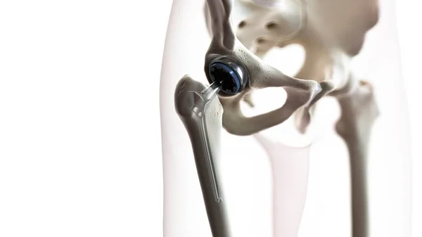 Hip Replacement Computer Illustration — Stock Photo, Image