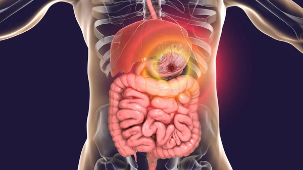 胃潰瘍 イラスト または消化性潰瘍は 胃の粘膜線の浸食です — ストック写真