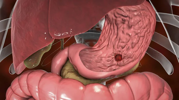 说明幽门螺杆菌引起的胃溃疡 胃溃疡是由幽门螺杆菌感染引起的胃粘膜内衬的侵蚀 — 图库照片