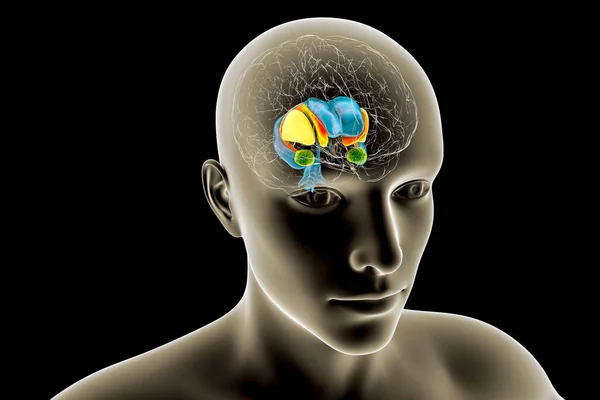 ハンティントン病患者の脳内の背側線条体と横室のイラスト 前頭葉角の拡大と前頭葉核の萎縮を示す — ストック写真