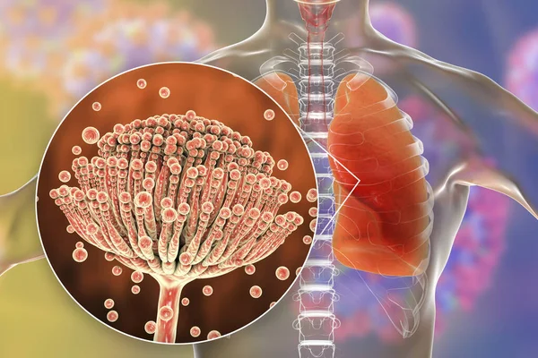 Εικονογράφηση Πνευμονικής Ασπεργίλλωσης Εισβολή Πνευμονικού Ιστού Από Μύκητες Μούχλας Aspergillus — Φωτογραφία Αρχείου