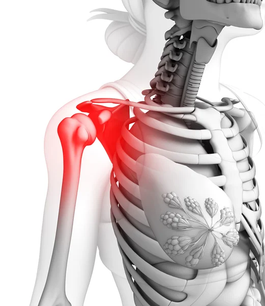 Human shoulder pain artwork — Stock Photo, Image