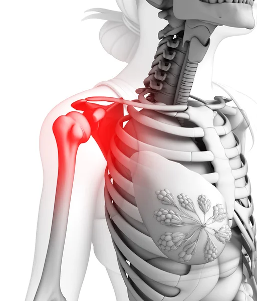 Human shoulder pain artwork — Stock Photo, Image