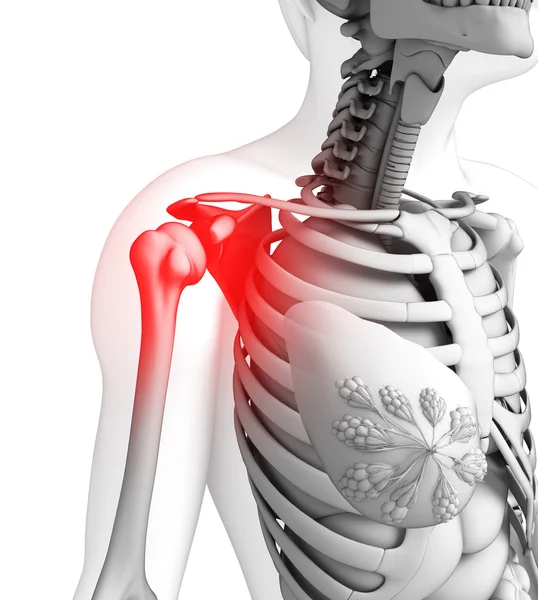 Human shoulder pain artwork — Stock Photo, Image